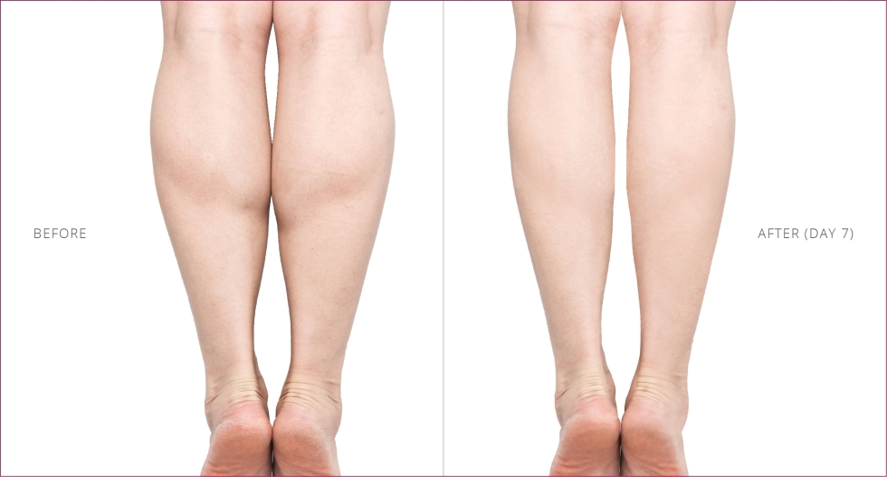 CalfMuscle 01-01